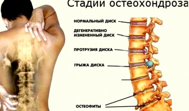 дегенеративные изменения позвоночника